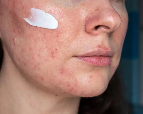 Skóra z niedoskonałościami, zaczerwienieniami i pryszczami. Na policzku biały krem, symbolizujący pielęgnację i nadzieję na kwas azelainowy efekty.